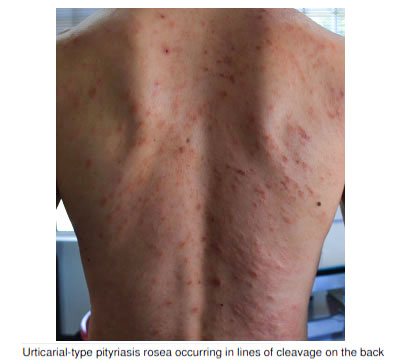 Dermatology Cases: Pityriasis Rosea and Pityriasis Versicolor - Healthed