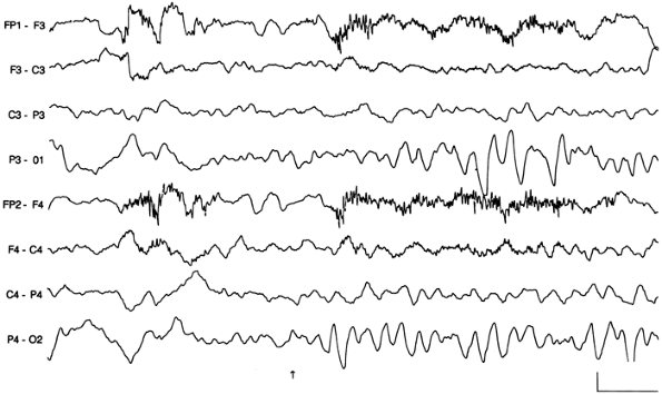 normal versus abnormal eeg